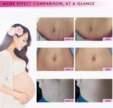 Stretch marks and pregnancy marks removal cream